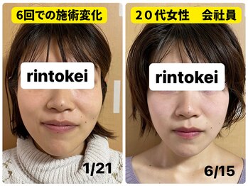 凛と慶/20代女性の施術変化