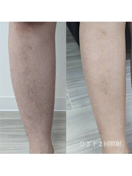 ワン(ONE)/ひざ下ビフォーアフター♪