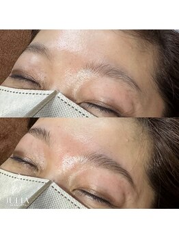 ジュリア(JULIA)/HBL（ハリウッドブロウリフト）