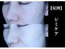 The水光美肌専科/アラフォーのシミケア