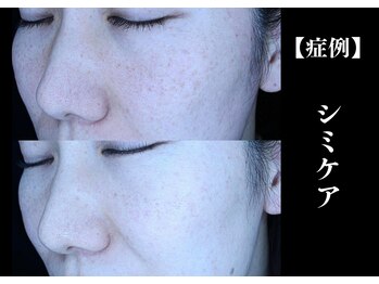 The水光美肌専科/アラフォーのシミケア