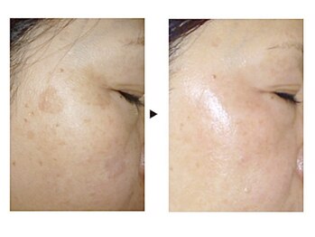 ビューティーガーデン(Beauty Garden)/シミケア