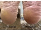 韓国式足裏角質ケア47