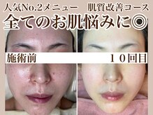 ディンプル(Dimple)