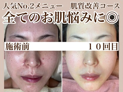 ディンプル(Dimple)の写真