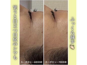 ハニエル(Haniel)/カーボキシー症例