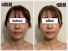 キプラ 福津店(KIPURA)/小顔矯正1回目