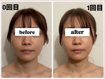 キプラ 福津店(KIPURA)/小顔矯正1回目