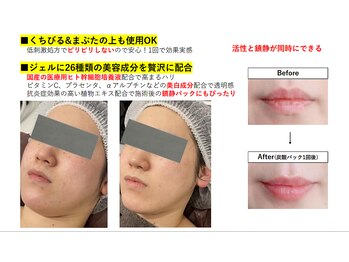 ウル(Ulu)/【高濃度ヒト幹導入炭酸パック】