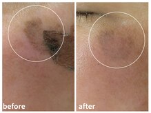 ラミーユ(La Miu)/諦めていたシミが薄く改善