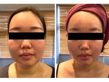 ルナグランデ(Luna grande.)/お顔 5mlの6回目