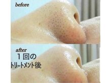 レゾン 京橋店/【ビフォーアフター】毛穴ケア