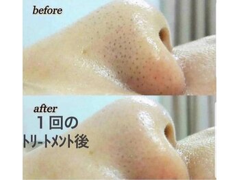 レゾン 京橋店/【ビフォーアフター】毛穴ケア