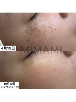 ミナミ(MINAMI)/毛穴気になりませんか？