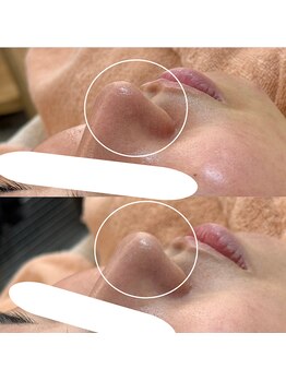 ミュー 春日井店(mieux)/◆肌質改善例