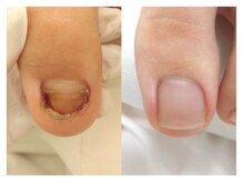 巻き爪ケアサポート ルアナ(LUANA)/Before→After