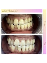 エクシアホワイトニング 仙台駅東口店/ホワイトニングビフォーアフター