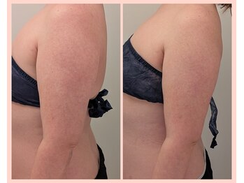 ワイズ(Y's)/背中＆二の腕　5回目