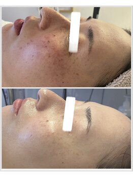 美しぐれ 溝の口/【5回】LDM/LED/酸素ドーム