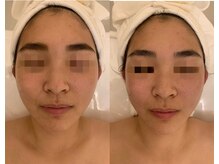 ナラビューティー(NARA BEAUTY)/コルギ1回効果