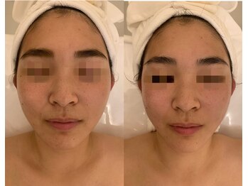 ナラビューティー(NARA BEAUTY)/コルギ1回効果