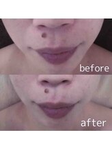 ブランシェ 野々市店 × 椿/シワ・たるみケア　お客様