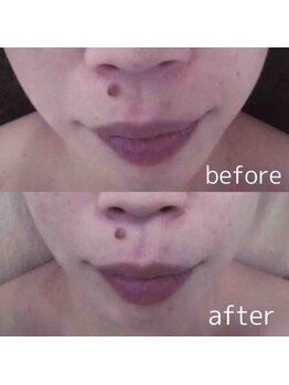 ブランシェ 野々市店 × 椿/シワ・たるみケア　お客様