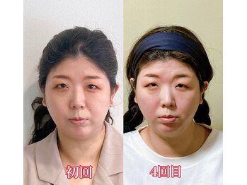 小顔22 ボルティ 赤坂支店(Bolty)/小顔シンメトリー矯正＆全身矯正