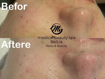 ベリア 広尾(BelLia)/マーメイドセルトリートメント