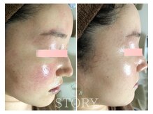 ストーリー(STORY)/ハーブピーリング専門店STORY