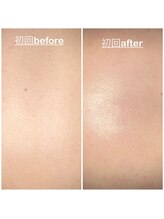 ミニョン(mignon)/この夏は背中美人に！