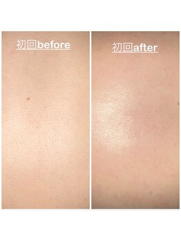 ミニョン(mignon)/この夏は背中美人に！