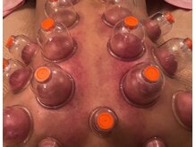 スイクウ ネオ(neo)/カッピング・吸玉　男性もOK