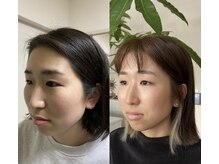 せせらぎ鍼灸院の雰囲気(院長の鬼美容鍼before&after)