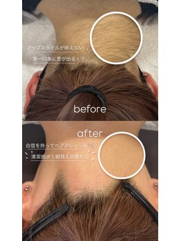 ナナイロサロン フクオカ(NaNairoサロン Fukuoka)/【えり足・うなじダブル脱毛】