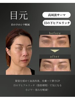 シェリー(Cherie)/目の下のシワと窪みを軽減