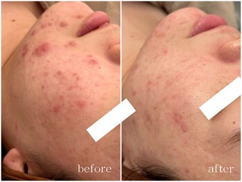 メゾンリュバン 天王寺(Maison Ruban)/ハーブピーリング|ニキビケア