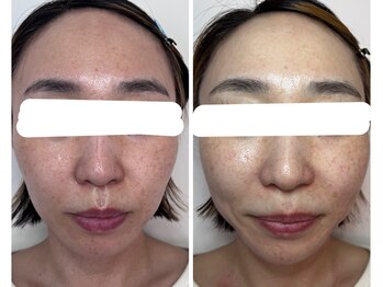 カヤ(KAYA)の写真/大人肌に、うるおいとハリ・ツヤを。ヒト幹細胞培養上清液を使用したスペシャルエイジングケア