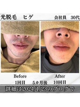 エスポワール(Espoir)/ヒゲの光脱毛 before⇒after
