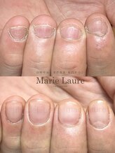 マリーロール 淀屋橋本店(Marie Laure)/自爪育成/深爪矯正/ネイルケア