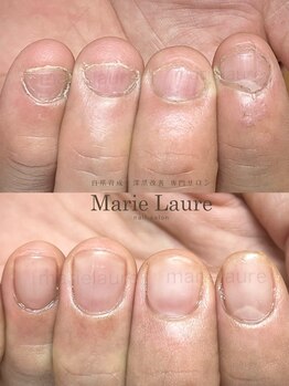 マリーロール 淀屋橋本店(Marie Laure)/自爪育成/深爪矯正/ネイルケア