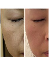 フォーケア(4Care)/プロセル肌質改善トリートメント