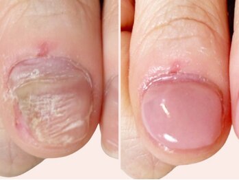 ココモ(cocomo)の写真/深爪や短い爪でお悩みの方におすすめ!「深爪矯正による長さ出し」と「フィルイン」で美しく自然な自爪に☆