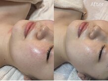 トーン(TONE)/むくみ / 赤み / 血行不良の改善