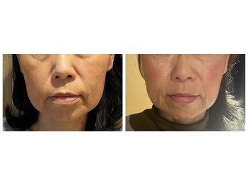 ねこのひげ/お顔の変化