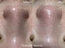 ナチュールムーン(Nature moon.)/毛穴洗浄