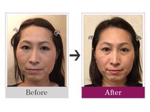 ビコツゼロ 青山(BIKOTSU ZERO)/小顔・顎の歪み・むくみ