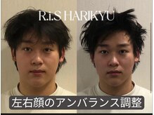 リス(R.i.S)/小顔矯正Before&After