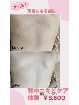 レゾン 京橋店/【ビフォーアフター】背中ケア