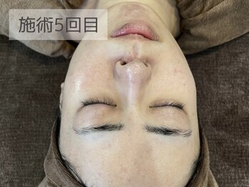 MTサロン 大名店/超音波洗浄の施術例１